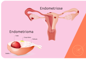 Endometriose é uma das doenças ginecológicas mais frequentes